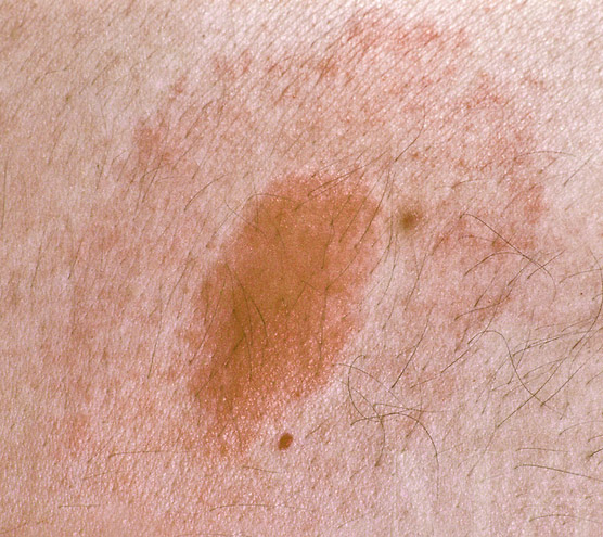 Tick Bite Rash, Pictures, Symptoms, Treatment, Photos, fever