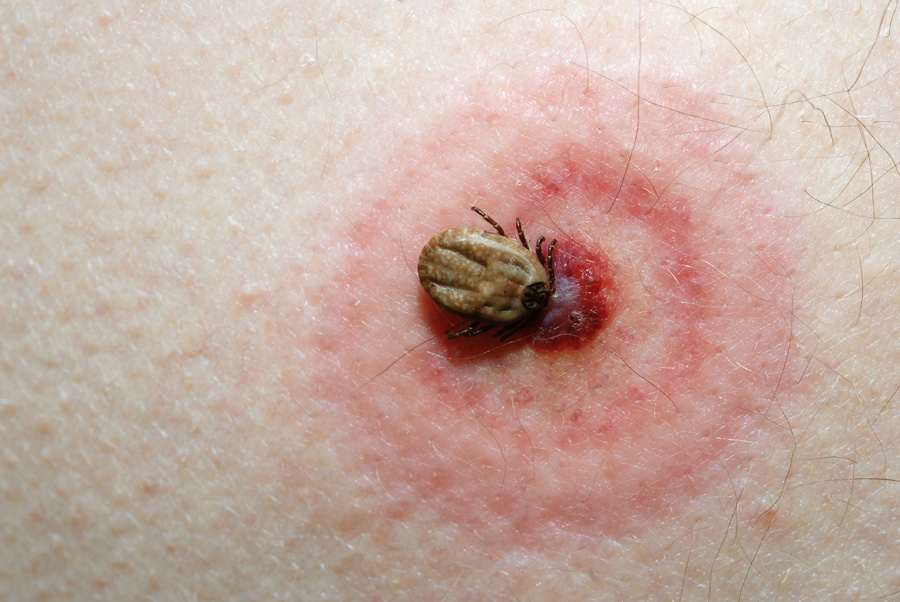 http://lymediseasecentralmass.com/wp-content/uploads/2016/06/Central-Mass-Lyme-disease-tick-bite.jpg