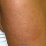lyme disease infection