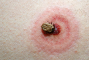 Lyme disease bullseye rash