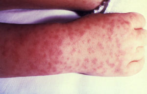Rocky_Mountain_spotted_fever_RASH