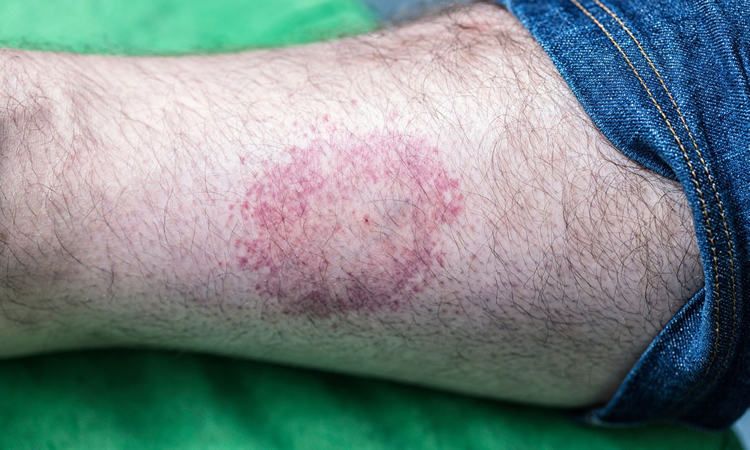 Lyme disease rash from a deer tick bite